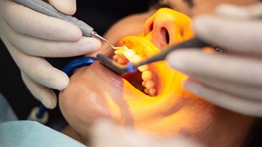 É possível ter um sorriso bonito e natural através da Prostodontia Fixa. Este tratamento concede uma ótima reabilitação estético-funcional.