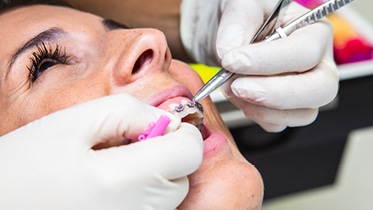 Orthodontics corrects dentofacial irregularities, aligning teeth, bone support, lips and facial balance.